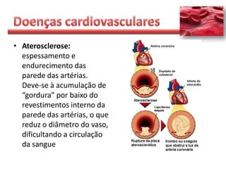• Aterosclerose:
  espessamento e
  endurecimento das
  parede das artérias.
  Deve-se à acumulação de
  “gordura” por baixo do
  revestimentos interno da
  parede das artérias, o que
  reduz o diâmetro do vaso,
  dificultando a circulação
  da sangue
 