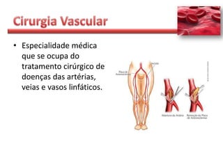 • Especialidade médica
  que se ocupa do
  tratamento cirúrgico de
  doenças das artérias,
  veias e vasos linfáticos.
 