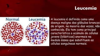 Leucemia
• A leucemia é definida como uma
doença maligna dos glóbulos brancos
de origem, na maioria das vezes, não
conhecida. Ela tem como principal
característica o acúmulo de células
jovens (blásticas) anormais na
medula óssea que substituem as
células sanguíneas normais.
 