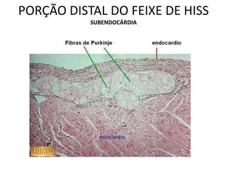 PORÇÃO DISTAL DO FEIXE DE HISS
SUBENDOCÁRDIA
 