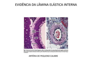 EVIDÊNCIA DA LÂMINA ELÁSTICA INTERNA
ARTÉRIA DE PEQUENO CALIBRE
 