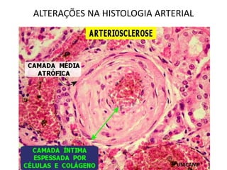 UNICAMP
ALTERAÇÕES NA HISTOLOGIA ARTERIAL
 