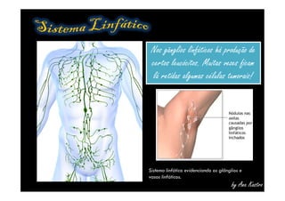 Nos gânglios linfáticos há produção de
certos leucócitos. Muitas vezes ficam
lá retidas algumas células tumorais!
Nos gânglios linfáticos há produção de
certos leucócitos. Muitas vezes ficam
lá retidas algumas células tumorais!
by Ana Kastro
Sistema linfático evidenciando os glânglios e
vasos linfáticos.
 