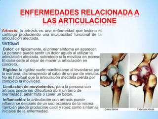 Artrosis: la artrosis es una enfermedad que lesiona el
cartílago produciendo una incapacidad funcional de la
articulación afectada.
SINTOMAS
Dolor: es típicamente, el primer síntoma en aparecer.
La persona puede sentir un dolor agudo al utilizar la
articulación afectada, sobretodo si la moviliza en exceso.
El dolor cede al dejar de mover la articulación en
concreto.
Rigidez: la rigidez suele manifestarse al levantarse por
la mañana, disminuyendo al cabo de un par de minutos.
No es habitual que la articulación afectada pierda por
completo la movilidad.
Limitación de movimientos: para la persona con
artrosis puede ser dificultoso abrir un tarro de
mermelada, pelar fruta o coser un botón.
Inflamación: la articulación con artrosis puede
inflamarse después de un uso excesivo de la misma.
También puede producirse calor y rojez como síntomas
iniciales de la enfermedad.
ENFERMEDADES RELACIONADA A
LAS ARTICULACIONE
 