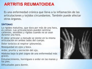 ARTRITIS REUMATOIDEA
Es una enfermedad crónica que lleva a la inflamación de las
articulaciones y tejidos circundantes. También puede afectar
otros órganos.
SÍNTOMAS
La rigidez matutina, que dura por más de una hora,
es común. Las articulaciones pueden sentirse
calientes, sensibles y rígidas cuando no se usan
durante una hora.
El dolor articular a menudo se siente en la misma
articulación en ambos lados del cuerpo.
Dolor torácico al respirar (pleuresía).
Resequedad en ojos y boca.
Ardor, prurito y secreción del ojo.
Nódulos bajo la piel (signo de una enfermedad más
grave).
Entumecimiento, hormigueo o ardor en las manos y
los pies.
Dificultades para dormir.
 