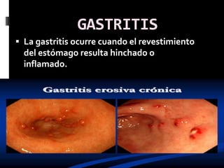 GASTRITIS
 La gastritis ocurre cuando el revestimiento
  del estómago resulta hinchado o
  inflamado.
 