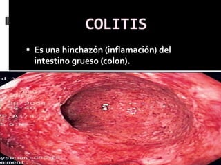 COLITIS
 Es una hinchazón (inflamación) del
  intestino grueso (colon).
 