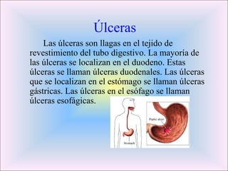 Úlceras 
Las úlceras son llagas en el tejido de 
revestimiento del tubo digestivo. La mayoría de 
las úlceras se localizan en el duodeno. Estas 
úlceras se llaman úlceras duodenales. Las úlceras 
que se localizan en el estómago se llaman úlceras 
gástricas. Las úlceras en el esófago se llaman 
úlceras esofágicas. 
 