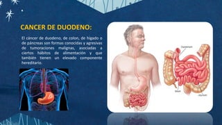 El cáncer de duodeno, de colon, de hígado o
de páncreas son formas conocidas y agresivas
de tumoraciones malignas, asociadas a
ciertos hábitos de alimentación y que
también tienen un elevado componente
hereditario.
CANCER DE DUODENO:
 