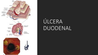 ÚLCERA
DUODENAL
 