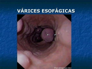 VÁRICES ESOFÁGICASVÁRICES ESOFÁGICAS
 
