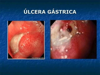 ÚLCERA GÁSTRICAÚLCERA GÁSTRICA
 