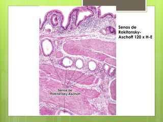 Senos de
Rokitansky-
Aschoff 120 x H-E
 