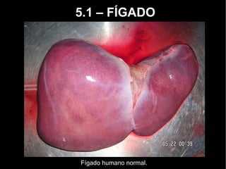 5.1 – FÍGADO
Fígado humano normal.
 