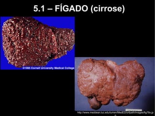 5.1 – FÍGADO (cirrose)
http://www.meddean.luc.edu/lumen/MedED/orfpath/images/fig78x.jp
 