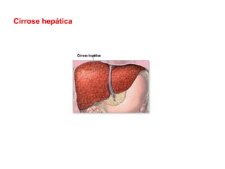 Cirrose hepática
 
