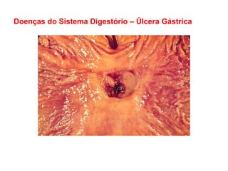 Doenças do Sistema Digestório – Úlcera Gástrica
 