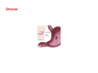 Úlceras
 