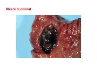 Úlcera duodenal
 