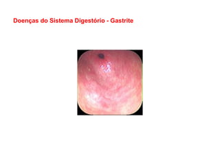 Doenças do Sistema Digestório - Gastrite
 