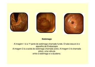 Estômago
A imagem 1 é a 1ª parte do estômago chamado fundo. O tubo escuro é o
aparelho de Endoscopia
A imagem 2 é a saída do estômago chamada antro. A imagem 3 é chamada
piloro, uma válvula
entre o estômago e o duodeno.
 