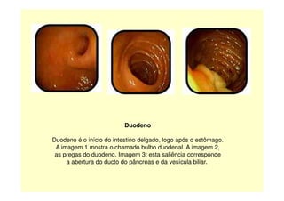 Duodeno
Duodeno é o início do intestino delgado, logo após o estômago.
A imagem 1 mostra o chamado bulbo duodenal. A imagem 2,
as pregas do duodeno. Imagem 3: esta saliência corresponde
a abertura do ducto do pâncreas e da vesícula biliar.
 