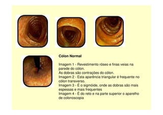 Cólon NormalCólon Normal
Imagem 1 - Revestimento róseo e finas veias na
parede do cólon.
As dobras são contrações do cólon.
Imagem 2 - Esta aparência triangular é frequente no
cólon transverso.
Imagem 3 - É o sigmóide, onde as dobras são mais
espessas e mais frequentes
Imagem 4 - É do reto e na parte superior o aparelho
de colonoscopia
 
