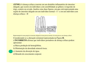 (UFMG) A doença celíaca consiste em um distúrbio inflamatório do intestino
delgado, que ocorre em indivíduos com sensibilidade ao glúten e à ingestão de
trigo, centeio ou cevada. Analise estas duas figuras, em que está representada uma
região do intestino delgado em um indivíduo normal – I – e em um indivíduo com
doença celíaca – II
Representação de uma porção do intestino delgado de uma pessoa normal e de uma pessoa com doença celíaca
Considerando-se a alteração estrutural representada na Figura II,
é INCORRETO afirmar que indivíduos portadores de doença celíaca podem
apresentar:
a) Baixa produção de hemoglobina.
b) Diminuição da densidade mineral óssea.
c) Aumento da absorção de água.
d) Retardo do crescimento corporal.
 
