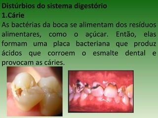 Distúrbios do sistema digestório
1.Cárie
As bactérias da boca se alimentam dos resíduos
alimentares, como o açúcar. Então, elas
formam uma placa bacteriana que produz
ácidos que corroem o esmalte dental e
provocam as cáries.
 