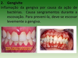 2. Gengivite
Inflamação da gengiva por causa da ação de
bactérias. Causa sangramentos durante a
escovação. Para preveni-la, deve-se escovar
levemente a gengiva.
 