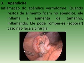 3. Apendicite
Inflamação do apêndice vermiforme. Quando
restos de alimento ficam no apêndice, ele
inflama e aumenta de tamanho,
inflamando. Ele pode romper-se (soporar)
caso não faça a cirurgia.
 