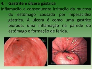 4. Gastrite e úlcera gástrica
Inflamação e consequente irritação da mucosa
do estômago causada por hiperacidez
gástrica. A úlcera é como uma gastrite
piorada, uma inflamação na parede do
estômago e formação de ferida.
 
