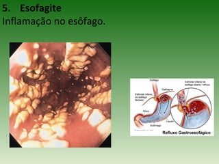 5. Esofagite
Inflamação no esôfago.
 