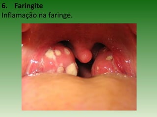 6. Faringite
Inflamação na faringe.
 