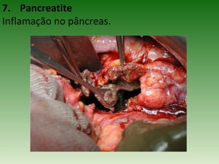 7. Pancreatite
Inflamação no pâncreas.
 