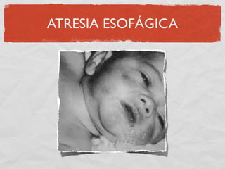 ATRESIA ESOFÁGICA
 