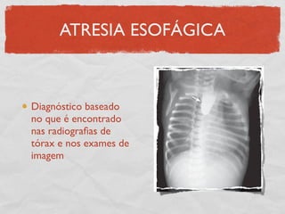 ATRESIA ESOFÁGICA
Diagnóstico baseado
no que é encontrado
nas radiograﬁas de
tórax e nos exames de
imagem
 