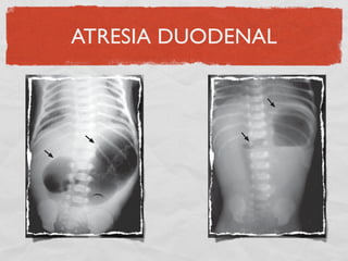 ATRESIA DUODENAL
 