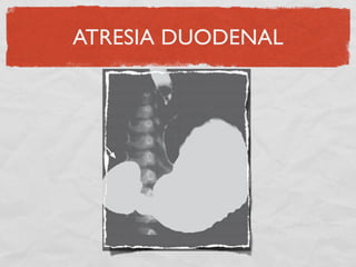 ATRESIA DUODENAL
 