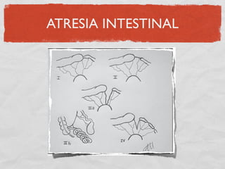 ATRESIA INTESTINAL
 