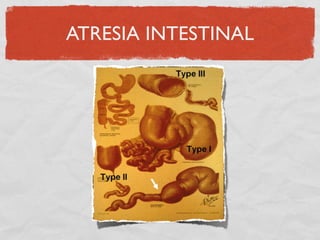 ATRESIA INTESTINAL
 