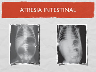 ATRESIA INTESTINAL
 