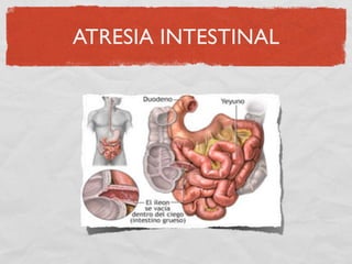 ATRESIA INTESTINAL
 
