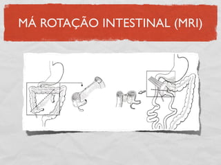 MÁ ROTAÇÃO INTESTINAL (MRI)
 