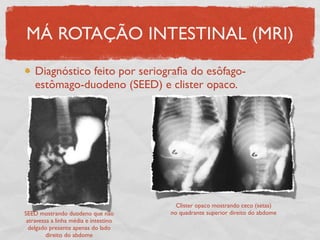 MÁ ROTAÇÃO INTESTINAL (MRI)
Diagnóstico feito por seriograﬁa do esôfago-
estômago-duodeno (SEED) e clister opaco.
SEED mostrando duodeno que não
atravessa a linha média e intestino
delgado presente apenas do lado
direito do abdome
Clister opaco mostrando ceco (setas)
no quadrante superior direito do abdome
 