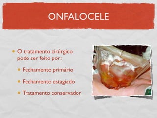 ONFALOCELE
O tratamento cirúrgico
pode ser feito por:
Fechamento primário
Fechamento estagiado
Tratamento conservador
 