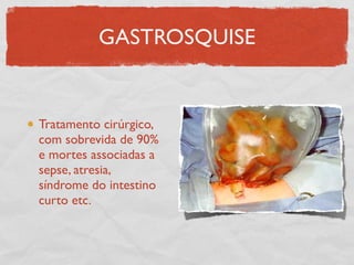 GASTROSQUISE
Tratamento cirúrgico,
com sobrevida de 90%
e mortes associadas a
sepse, atresia,
síndrome do intestino
curto etc.
 