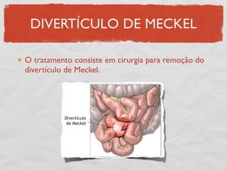 DIVERTÍCULO DE MECKEL
O tratamento consiste em cirurgia para remoção do
divertículo de Meckel.
 