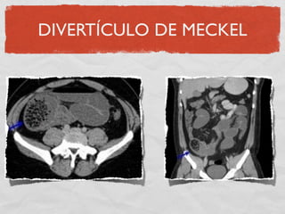 DIVERTÍCULO DE MECKEL
 
