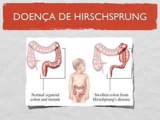 DOENÇA DE HIRSCHSPRUNG
 